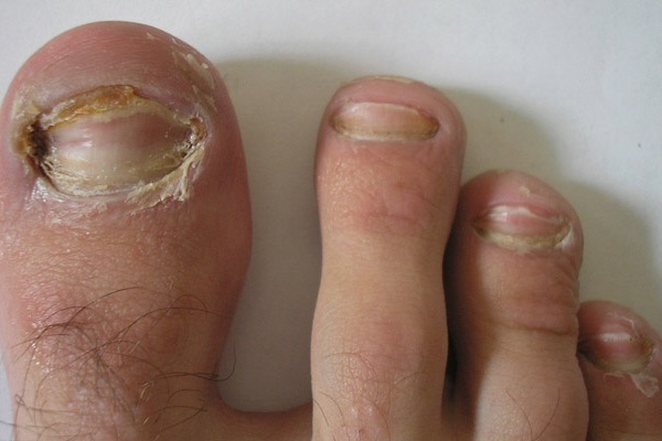 علت سیاه شدن ناخن پا و روشهای خانگی برای پیشگیری و درمان