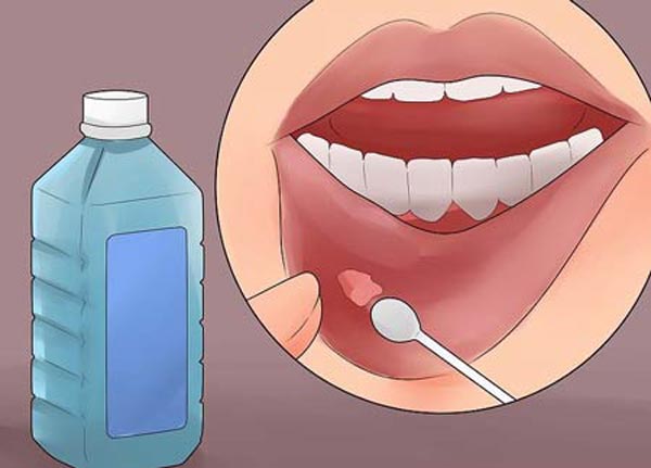 رویکرد پزشکی در درمان آفت دهان کودک