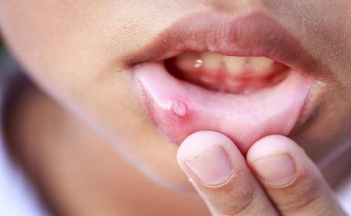 روش‌های درمان آفت دهان کودکان