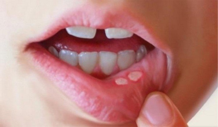 درمان سریع آفت دهان: روش های خانگی، داروهای بدون نسخه و خوردنی ها