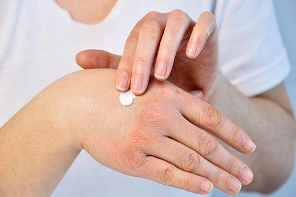 خشکی پوست دست را یک شبه درمان کنید!