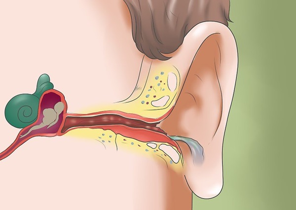 درمان التهاب گوش 