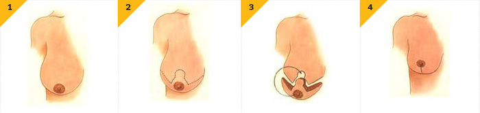 جراحی کوچک کردن سینه چیست؟ چگونه انجام میشود؟ + هزینه و عوارض