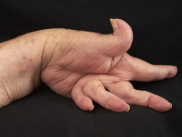 آرتروز انگشتان دست؛ علائم و راه های درمان