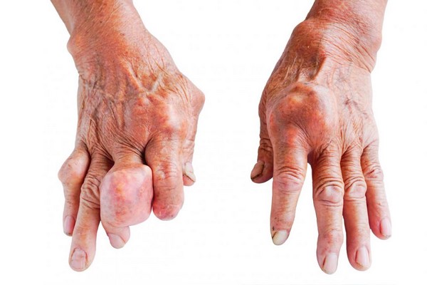 آرتروز انگشتان دست؛ علائم و راه های درمان