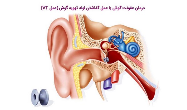 درمان عفونت گوش با استفاده از دارو و روش‌های خانگی