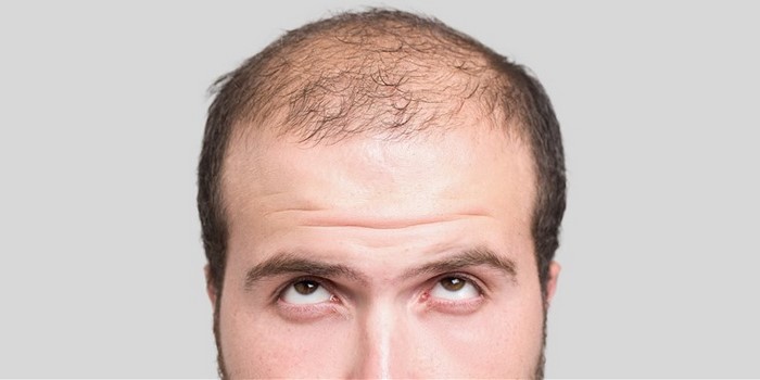 ریزش مو و ۷ روش درمان طبیعی آن در منزل