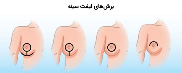 جراحی لیفت سینه چیست؟ بررسی مزایا، عوارض و مراقبت های لازم