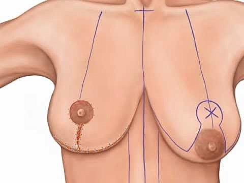 جراحی لیفت سینه چیست؟ بررسی مزایا، عوارض و مراقبت های لازم