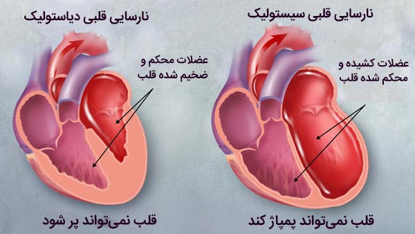 انواع نارسایی قلب