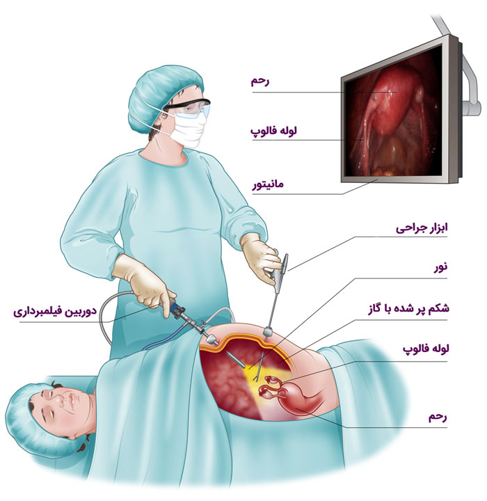 عمل لاپاراسکوپی