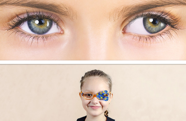 تنلی چشم در کودکان چیست و چگونه درمان می شود؟