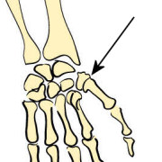 مفصل زینی شکل در انگشت‌ها