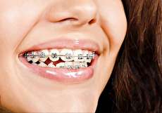 عوارض ارتودنسی چیست؟