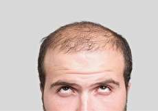 علت ریزش مو در مردان جوان چیست؟