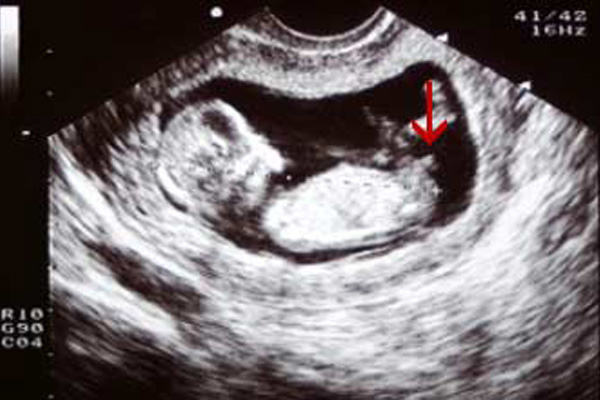 تعیین جنسیت جنین در هفته ۱۲ بارداری، از خرافه تا واقعیت