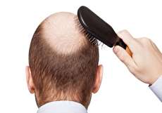 بهترین درمان ریزش مو چیست؟