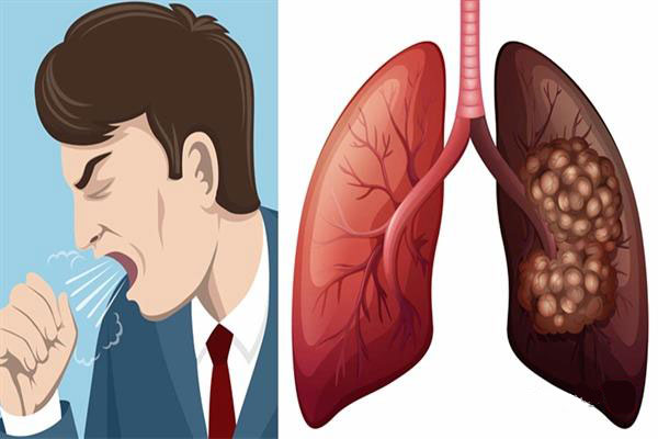 ساز و کار درمان عفونت ریه، تولید مایه مخاطی در ریه، سرفه تلاشی‌ست برای تخلیه این مخاط