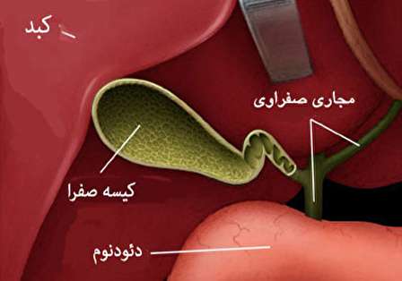 عوارض برداشتن کیسه صفرا چیست؟