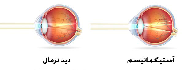 آستیگمات چشم - چشم سالم و چشم مبتلا به آستیگماتیسم