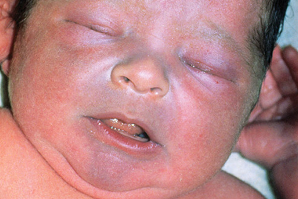 سیانوز در نوزادان یا سندروم نوزاد آبی