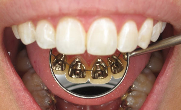 ارتودنسی نامرئی براکت پشت دندانی یا لینگوال