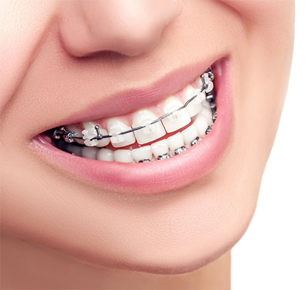 ارتودنسی نامرئی با براکت همرنگ دندان یا براکت سرامیکی