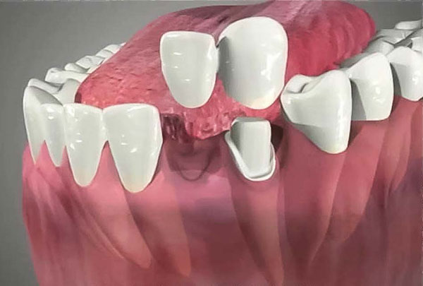 بریج دندان به صورت معلق