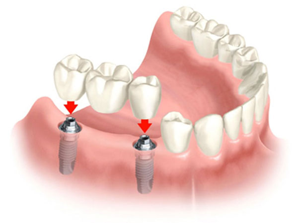 بریج دندان با حمایت از ایمپلنت