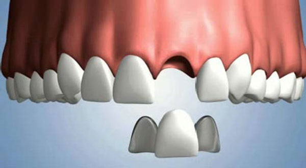 بریج دندان به صورت رزینی پیوندی