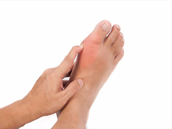 درمان نقرس پا با درمان‌های طبیعی