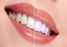 بروساژ دندان چیست و چگونه انجام میشود؟