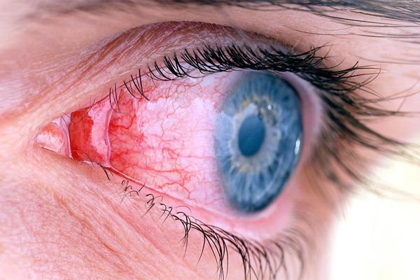 بیماری چشم صورتی؛ علت، تشخیص و راه درمان