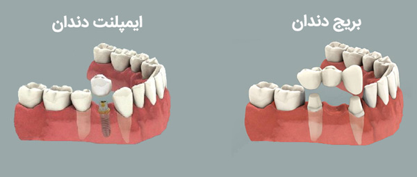 ایمپلت دندان و بریج دندان