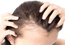 اسکالپ سر؛ روشی برای زیباتر دیده شدن + مزایا و معایب