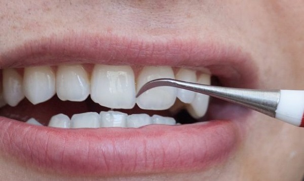 جرم گیری دندان در خانه؛ چگونه پلاک و تارتار را در خانه از بین ببریم؟