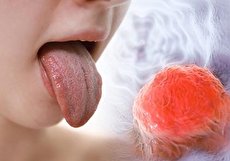 علائم سرطان زبان، علل و روشهای درمانی آن را بشناسید