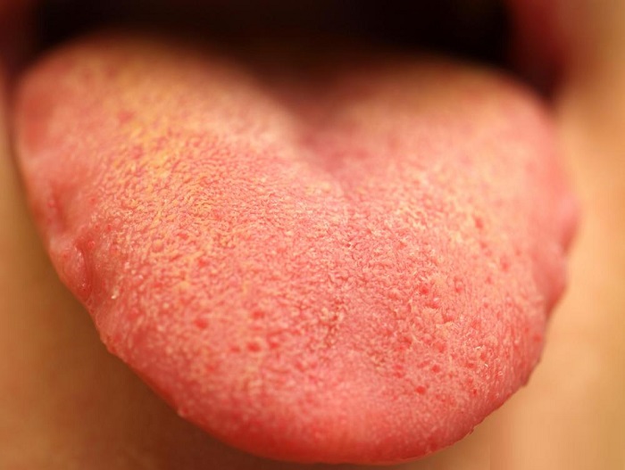علت زردی روی زبان چیست و چطور درمان می‌شود؟