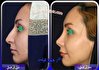 آشنایی با انواع عمل بینی - دکتر حامد عباسی
