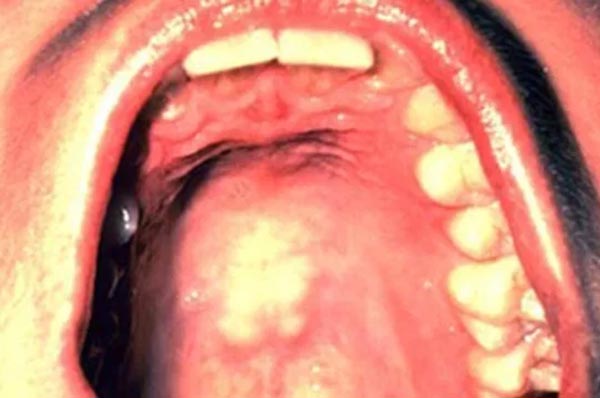 علائم سرطان دهان 