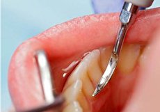 برای رفع جرم پشت دندان های جلو چه باید کرد؟