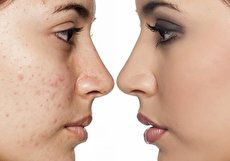 بررسی عوارض کرم پودر دائم در مقابل مزایای آن!