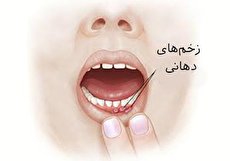 علائم سرطان دهان چیست و نحوهی تشخیص آن چگونه است؟