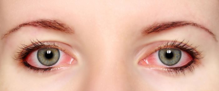 درمان برق زدگی چشم