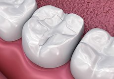 فیشور سیلانت چیست، چه مزایایی دارد و برای چه کسانی مناسب است؟