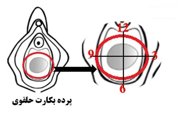 آسیب دیدگی پرده بکارت حلقوی چگونه است؟