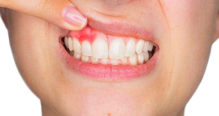 درمان خانگی آبسه دندان