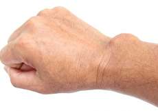 علل و علایم سرطان سارکوم چیست و آیا درمان میشود؟