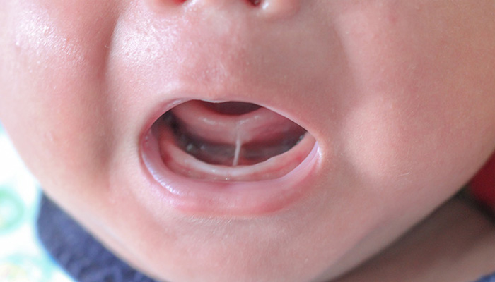 چسبندگی زبان به کف دهان نوزاد: دلایل، نشانه ها و راه های درمان