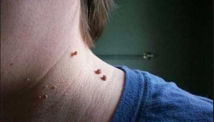روشهای پزشکی و خانگی برداشتن خال گوشتی روشهای پزشکی و خانگی برداشتن خال گوشتی